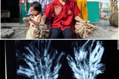 BIG REVEAL: The man from Bangladesh living with “Tree Man Syndrome” finally holds his daughter after 16 grueling surgeries – A rare genetic nightmare turning flesh to wood, ostracized and misunderstood, yet defying all odds!